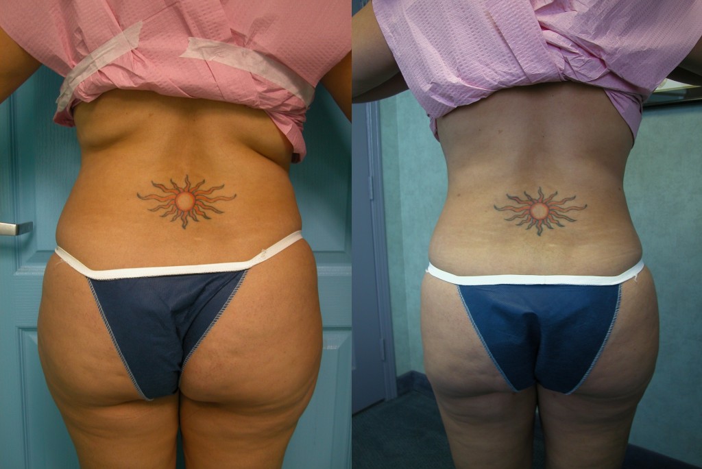 Tumescent Liposculpture, Temecula - before and after photos