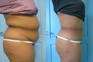 Fat reduction Temecula