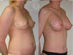 Natural Breast Augmentation