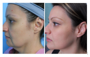 Neck Lift Before & After Photos
