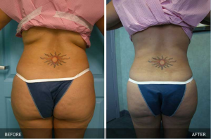 Smartlipo™ Before and After Photos