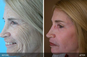 Skin Rejuvenation Before & After Photos