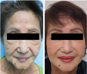 Before and After Liquid Facelift