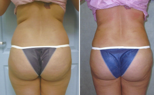 Buttock Augmentation Using Fat Transfer - Before and After Picture