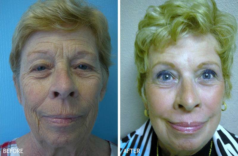 Skin Rejuvenation Patient Before & After 1