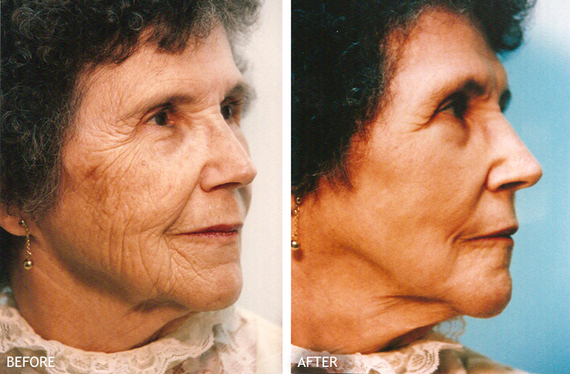 Skin Rejuvenation Patient Before & After 2