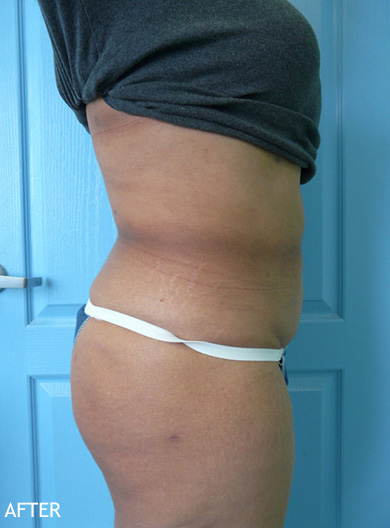 Liposculpture Patient After