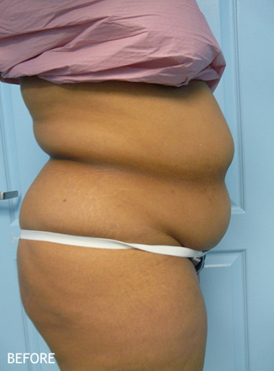 Liposculpture Patient Before