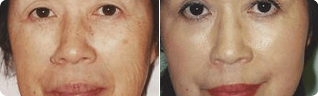Skin Lesion Removal Patient Before & After 1