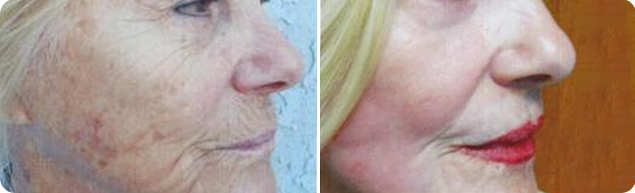 Skin Lesion Removal Patient Before & After 2