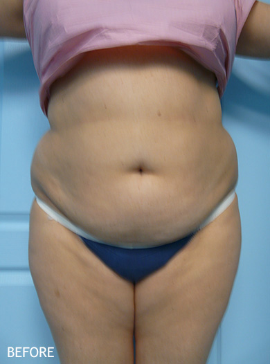 Non Invasive Body Contouring Patient Before