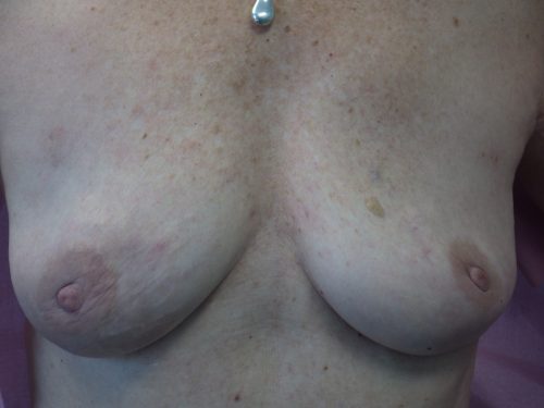 Natural Breast Augmentation Patient 21 After