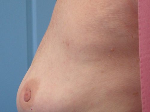 Natural Breast Augmentation Patient 21 After - 2