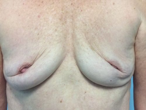 Natural Breast Augmentation Patient 21 Before