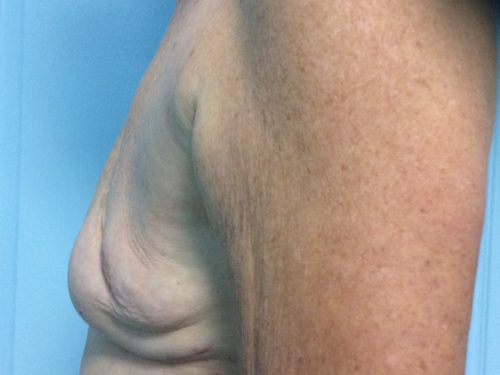 Natural Breast Augmentation Patient 21 Before - 2