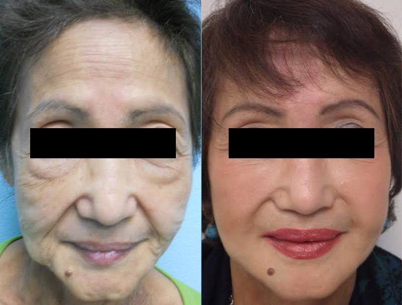 Liquid Facelift Patient Before & After 1