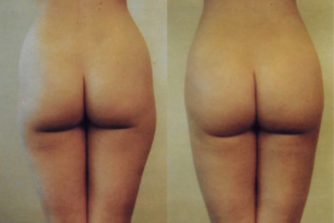 brazilian butt lift before and after
