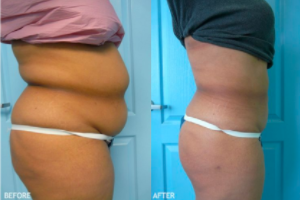 Liposuction Before and After Photos