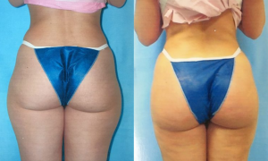 Butt Augmentation by Dr. ONeil