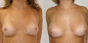 Natural Breast Augmentation by ONeil