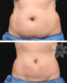 Coolsculpting Patient by Dr. Oneil