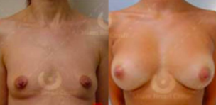 Fat Transfer Breast Augmentation Before and After Photos