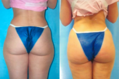 Fat Transfer Butt Augmentation Before and After Results