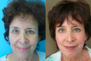 Skin Rejuvenation Patient by Dr. ONeil