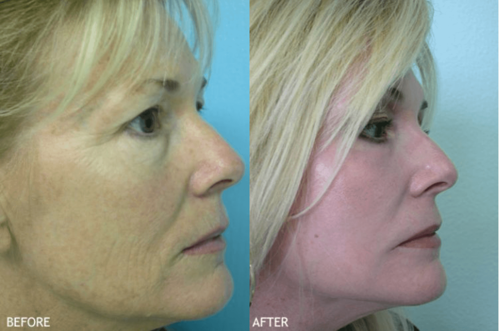 Chemical Peel Patient Before & After 2