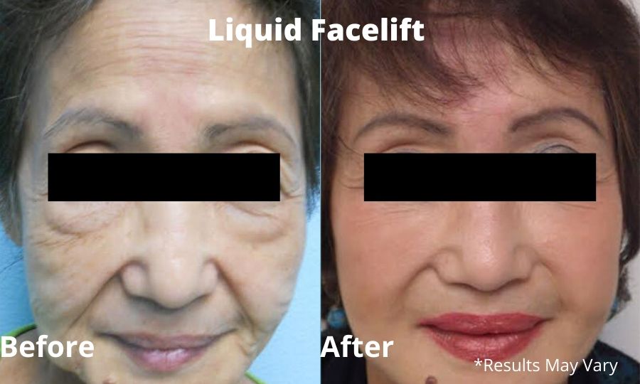 Liquid facelift before and after by Dr. Kelly O'Neil