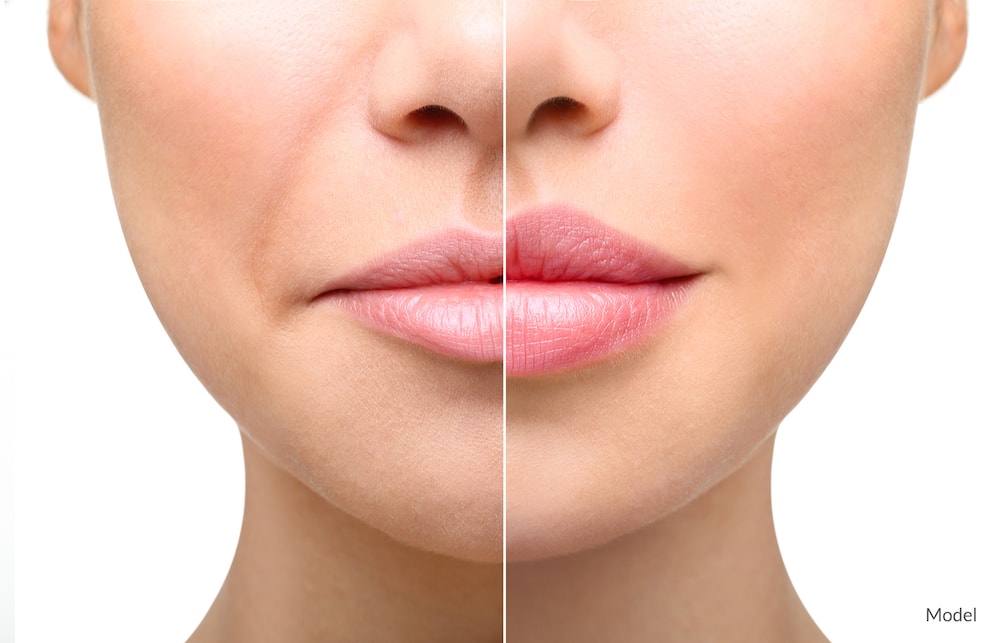 Before and after image showing the potential results of a lip filler.