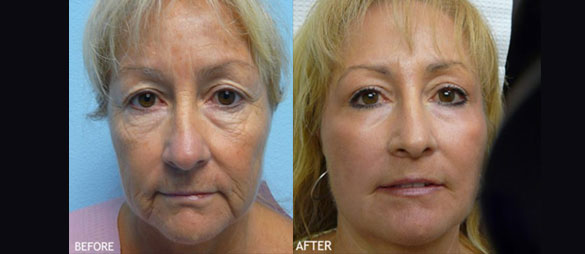 Home Patient Before & After 1