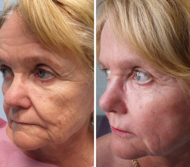 Before and after photo of Fat Transfer to the face