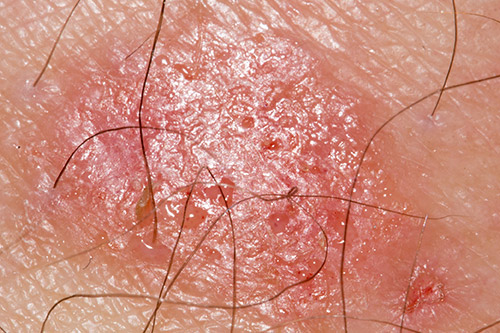 skin lesions