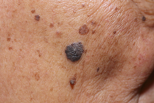 moles
