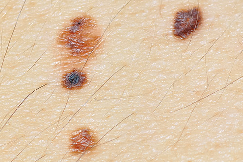 precancerous lesions