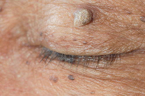 skin tags