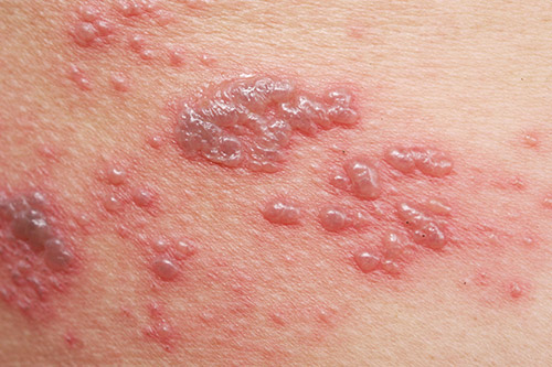 warts