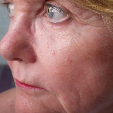 Skin-Rejuvenation-Patient-19 | After Skin Rejuvenation