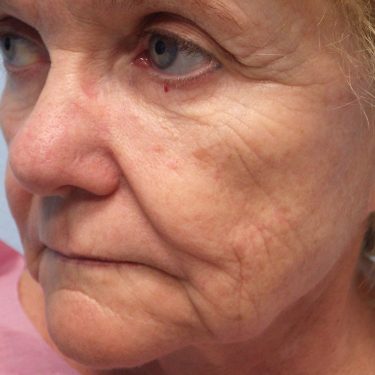 Injectable-Fillers-Patient-10 | Before Non-Surgical