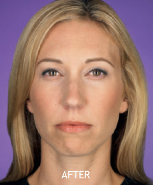 BOTOX---Cosmetic-Patient-01 | After Botox® Cosmetic