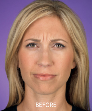 BOTOX---Cosmetic-Patient-01 | Before Botox® Cosmetic