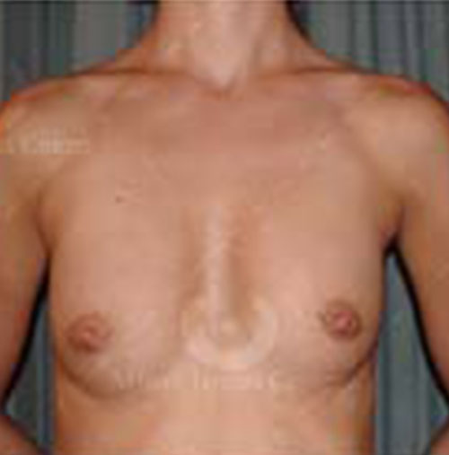 Natural-Breast-Augmentation-Patient-10 | After Breast