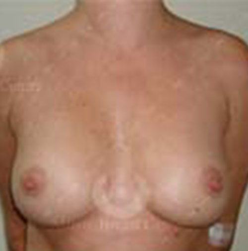 Natural-Breast-Augmentation-Patient-12 | After Natural Breast Augmentation