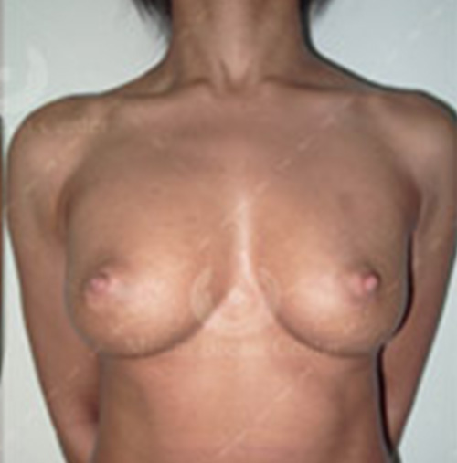 Natural-Breast-Augmentation-Patient-18 | After Natural Breast Augmentation