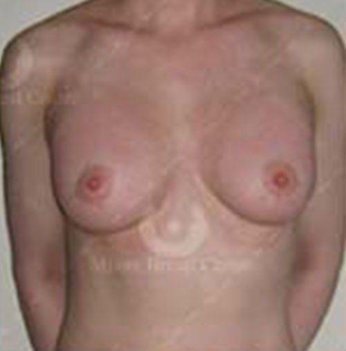 Natural-Breast-Augmentation-Patient-04 | After Breast