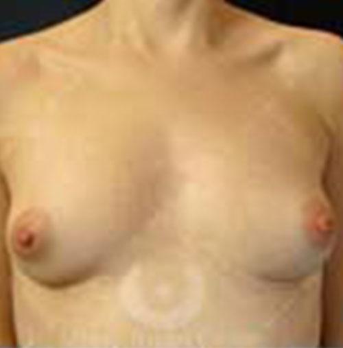 Natural-Breast-Augmentation-Patient-06 | After Breast