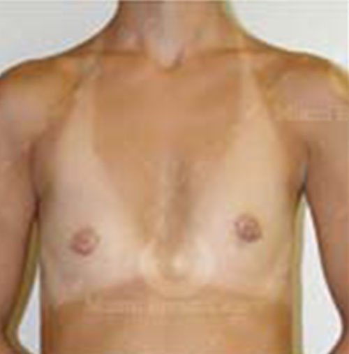 Natural-Breast-Augmentation-Patient-10 | Before Breast