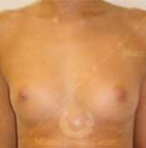 Natural-Breast-Augmentation-Patient-11 | Before Natural Breast Augmentation