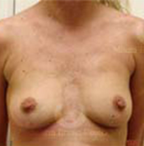 Natural-Breast-Augmentation-Patient-12 | Before Natural Breast Augmentation